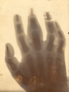 Pioneer xray of a hand