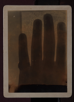 xray of the bones of a hand