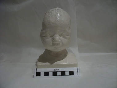 Plaster cast of the head of the first baby to be delivered under anaesthesia by the use of ether, 1847