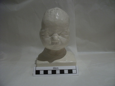 Plaster cast of the head of the first baby to be delivered under anaesthesia by the use of ether, 1847