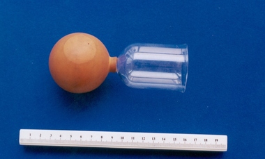 Cupping glass associated with midwife Mary Howlett, c. 1866 - 1920
