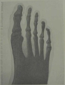 Lyle Radiograph