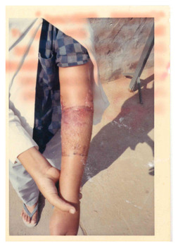 Coloured photo of young boy with injured arm.