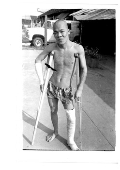 Black and white photo of a man on crutches with plaster on right arm and left leg. An ex white mouse now a prisoner.