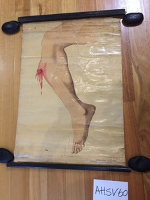 Chart, medical, human body, right leg fracture