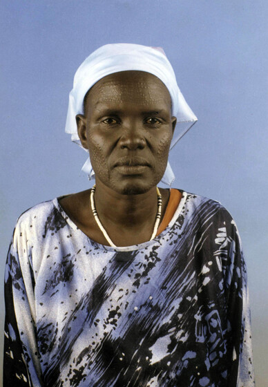 Middle aged woman wearing a blue, white and black patterned top, a white beaded necklace and white scarf on her head with no hair showing. Across her cheeks, chin and forehead is a repeating pattern of raised dots on her skin.